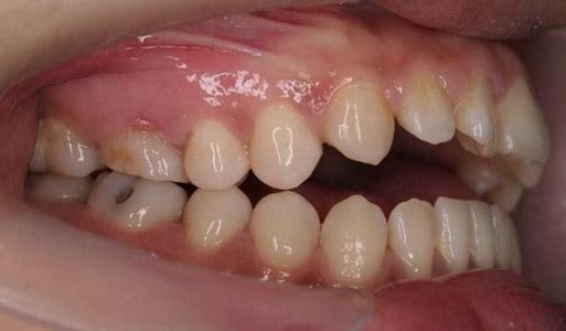 【福州】什么情况的牙齿要做矫正？