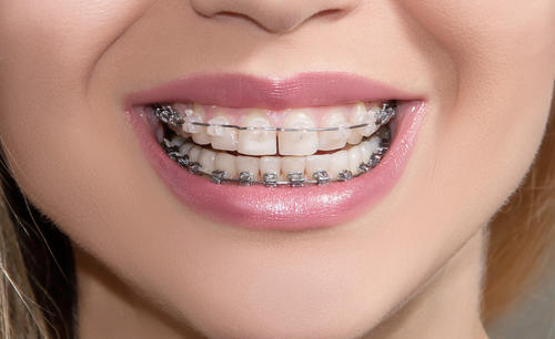 【福州】牙齿矫正是否真的会伤牙？