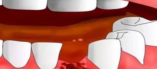 拔牙后居然不能吐口水?很多人