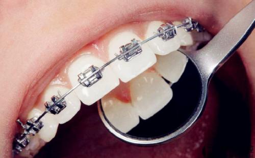 【福州】牙齿矫正期间能否洁牙呢？
