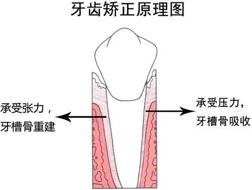 【福州】牙齿矫正是根据什么原理来的呢？