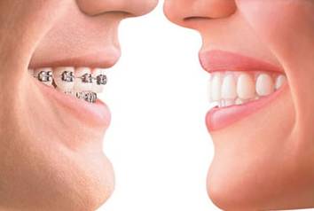 【福州】牙齿矫正，如何选择适合自己的矫治器