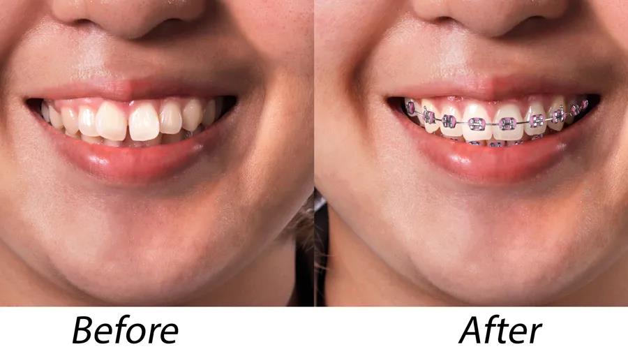 【福州】牙齿不整齐要不要做牙齿矫正？