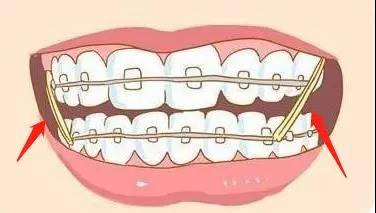 【福州】牙齿矫正时戴的小皮筋有什么用？