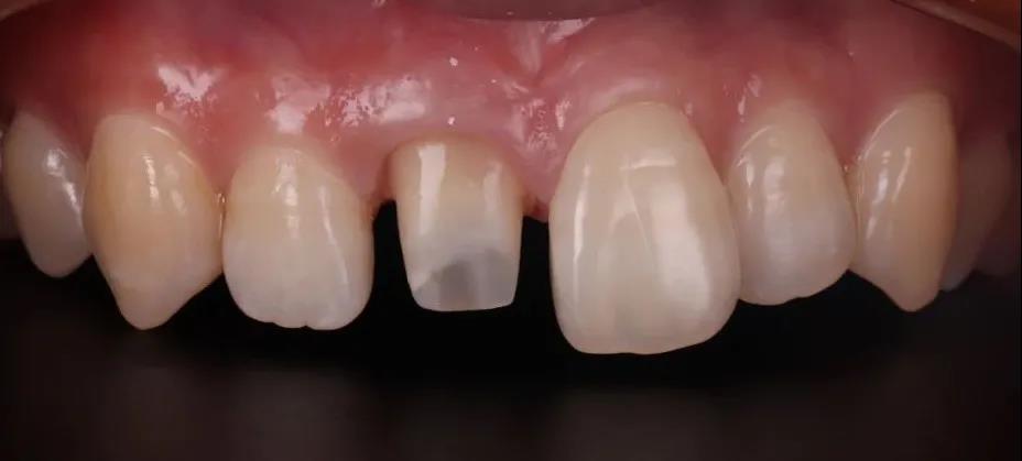 【福州】什么是“临时牙”？为什么要做临时牙