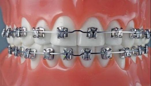 【福州】矫正牙齿的过程中，是否会发生疼痛?