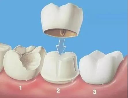 【福州】根管治疗后，为何要戴个牙冠？