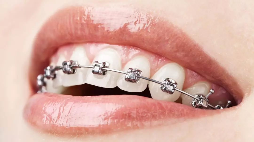 【福州】牙齿矫正自锁和非自锁的区别？