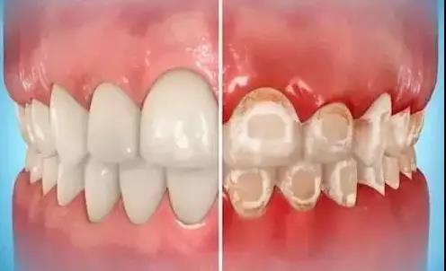 【福州】牙齿矫正期间，如何做好牙齿清洁？