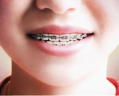 【福州】矫正会导致牙齿松动吗？